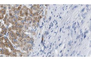 ABIN6274214 at 1/100 staining Human liver cancer tissue by IHC-P. (MARK3 Antikörper  (N-Term))