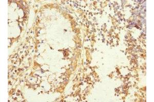 Immunohistochemistry of paraffin-embedded human colon cancer using ABIN7165806 at dilution of 1:100 (MEMO1 Antikörper  (AA 1-297))