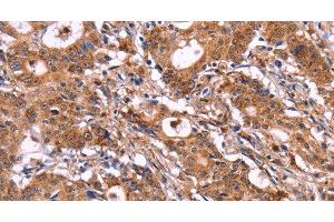 Immunohistochemistry of paraffin-embedded Human gastic cancer using SIGLEC5 Polyclonal Antibody at dilution of 1:30 (SIGLEC5 Antikörper)