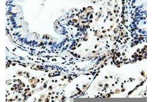 Immunohistochemical staining of paraffin-embedded Adenocarcinoma of Human breast tissue using anti-NT5DC1 mouse monoclonal antibody.
