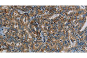 Immunohistochemistry of paraffin-embedded Human thyroid cancer tissue using PPARGC1B Polyclonal Antibody at dilution 1:30 (PPARGC1B Antikörper)