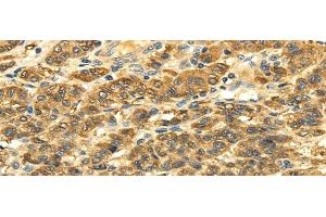 Immunohistochemistry of paraffin-embedded Human liver cancer tissue using SLC6A19 Polyclonal Antibody at dilution 1:35