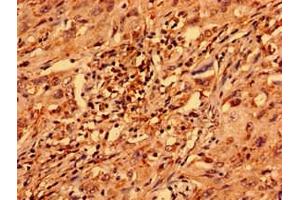 Immunohistochemistry analysis of human lung cancer using ABIN7176355 at dilution of 1:100 (ZNF529 Antikörper  (AA 393-563))