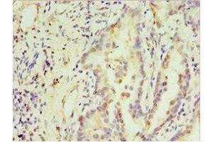 Immunohistochemistry of paraffin-embedded human lung cancer using ABIN7171237 at dilution of 1: 100