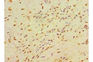 Immunohistochemistry of paraffin-embedded human breast cancer using ABIN7146714 at dilution of 1:100 (CA14 Antikörper  (AA 16-290))