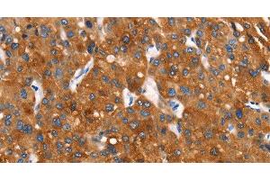 Immunohistochemistry of paraffin-embedded Human liver cancer tissue using Cytochrome b Polyclonal Antibody at dilution 1:30 (Cytochrome b Antikörper)