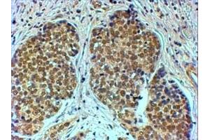 IHC testing of FFPE human breast cancer with TIF1A antibody at 4ug/ml. (TRIM24 Antikörper)