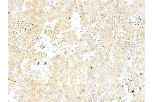 ABIN6258159 and ABIN6273892 at 1/100 staining human hepatocellular carcinoma by IHC-P.