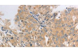 Immunohistochemistry of paraffin-embedded Human ovarian cancer tissue using HCRTR2 Polyclonal Antibody at dilution 1:50 (HCRTR2 Antikörper)