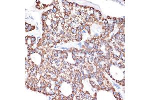 Immunohistochemistry of paraffin-embedded human liver cancer using GABA transaminase (GABA transaminase (ABAT)) Rabbit mAb (ABIN7265336) at dilution of 1:100 (40x lens). (ABAT Antikörper)