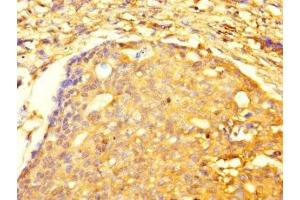 Immunohistochemistry of paraffin-embedded human gastric cancer using ABIN7173479 at dilution of 1:100 (TRIM74 Antikörper  (AA 47-249))