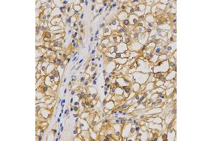 Immunohistochemistry of paraffin-embedded human stomach cancer using GRIA1 antibody at dilution of 1:200 (x400 lens) (Glutamate Receptor 1 Antikörper  (AA 19-300))