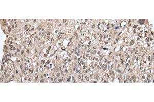 Immunohistochemistry of paraffin-embedded Human lung cancer tissue using METAP1D Polyclonal Antibody at dilution of 1:60(x200) (MAP1D Antikörper)
