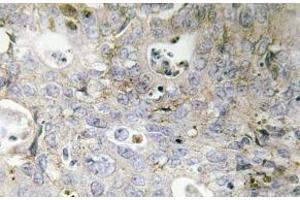 Immunohistochemistry (IHC) analyzes of Laminin gamma-1 antibody in paraffin-embedded human colon carcinoma tissue. (Laminin gamma 1 Antikörper)