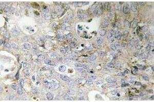 Immunohistochemistry (IHC) analyzes of Laminin gamma-1 antibody in paraffin-embedded human colon carcinoma tissue.