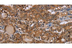 Immunohistochemistry of paraffin-embedded Human thyroid cancer using MT-ND1 Polyclonal Antibody at dilution of 1:50 (MT-ND1 Antikörper)
