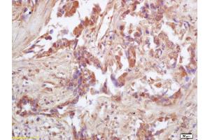 Formalin-fixed and paraffin embedded human lung carcinoma labeled with Rabbit Anti IDH2 Polyclonal Antibody, Unconjugated (ABIN751558) at 1:200 followed by conjugation to the secondary antibody and DAB staining (IDH2 Antikörper  (AA 251-350))
