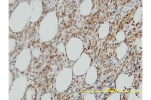 Immunoperoxidase of monoclonal antibody to ISGF3G on formalin-fixed paraffin-embedded human malignant lymphoma, diffuse large B tissue. (IRF9 Antikörper  (AA 1-393))