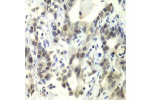 Immunohistochemistry of paraffin-embedded human gastric cancer using E2F6 antibody. (E2F6 Antikörper)