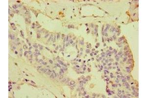 Immunohistochemistry of paraffin-embedded human endometrial cancer using ABIN7148730 at dilution of 1:100 (CDCP1 Antikörper  (AA 523-836))