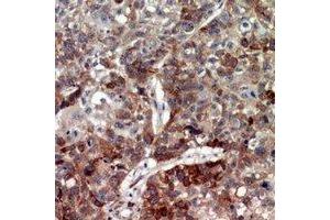 Immunohistochemical analysis of CD208 staining in human lung cancer formalin fixed paraffin embedded tissue section. (LAMP3 Antikörper)