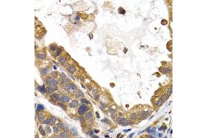 Immunohistochemistry of paraffin-embedded human stomach cancer using GYS1 antibody (ABIN5971351) at dilution of 1/200 (40x lens). (Glycogen Synthase 1 Antikörper)