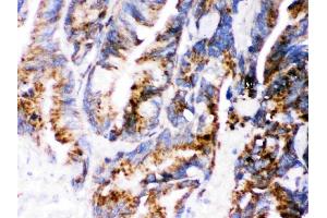 IHC analysis of Cathepsin D using anti-Cathepsin D antibody (ABIN3044509). (Cathepsin D Antikörper  (AA 201-412))