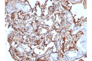Formalin-fixed, paraffin-embedded human Melanoma stained with MCAM Mouse Monoclonal Antibody (MCAM/1101). (MCAM Antikörper)