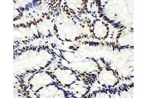 IHC-P: HDAC3 antibody testing of human intestinal cancer tissue (HDAC3 Antikörper  (AA 411-428))