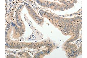 The image on the left is immunohistochemistry of paraffin-embedded Human colon cancer tissue using ABIN7189660(ADAMTS2 Antibody) at dilution 1/25, on the right is treated with synthetic peptide. (Adamts2 Antikörper)