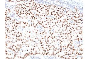 Formalin-fixed, paraffin-embedded human Breast Carcinoma stained with Progesterone Receptor Mouse Monoclonal Antibody (PR500). (Progesterone Receptor Antikörper)