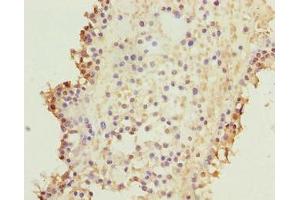 Immunohistochemistry of paraffin-embedded human breast cancer using ABIN7157640 at dilution of 1:100 (KIF26B Antikörper  (AA 8-133))