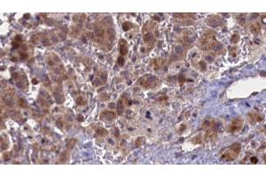 ABIN6276849 at 1/100 staining Human liver cancer tissue by IHC-P. (CHRNA5 Antikörper  (Internal Region))