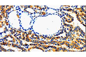 Immunohistochemistry of paraffin-embedded Human thyroid cancer using AIMP2 Polyclonal Antibody at dilution of 1:50 (AIMP2 Antikörper)