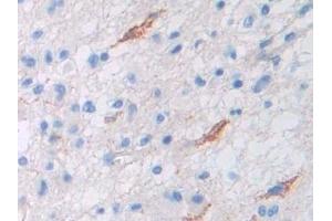 Detection of Pgp in Human Glioma Tissue using Polyclonal Antibody to Permeability Glycoprotein (Pgp)