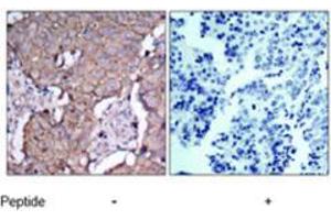 Immunohistochemical analysis of paraffin-embedded human breast carcinoma tissue using ERBB2 polyclonal antibody  . (ErbB2/Her2 Antikörper)