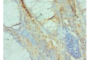 Immunohistochemistry of paraffin-embedded human colon cancer using ABIN7152531 at dilution of 1:100 (GFER Antikörper  (AA 81-205))