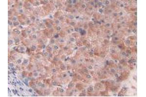 IHC-P analysis of Human Liver Cancer Tissue, with DAB staining. (HIF1A Antikörper  (AA 218-506))