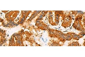 Immunohistochemistry of paraffin-embedded Human thyroid cancer tissue using ASMTL Polyclonal Antibody at dilution of 1:100(x200) (ASMTL Antikörper)