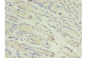 Immunohistochemistry of paraffin-embedded human gastric cancer using ABIN7150974 at dilution of 1:100 (RANBP2 Antikörper  (AA 2601-2802))