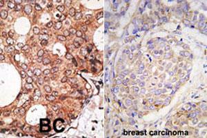 Formalin-fixed and paraffin-embedded human breast carcinoma tissue reacted with MAGEA10 polyclonal antibody  , which was peroxidase-conjugated to the secondary antibody, followed by DAB staining. (MAGEA10 Antikörper  (C-Term))