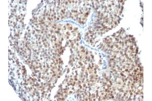 Formalin-fixed, paraffin-embedded human Bladder Carcinoma stained with ER-beta Mouse Monoclonal Antibody (ESR2/686). (ESR2 Antikörper  (C-Term))
