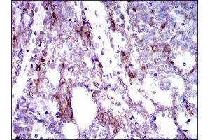 Immunohistochemical analysis of paraffin-embedded esophageal cancer tissues using CK5 mouse mAb with DAB staining. (Cytokeratin 5 Antikörper  (AA 316-590))