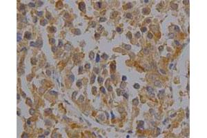 Immunohistochemical staining of human liver cancer tissue section with PRDX6 monoclonal antibody, clone 36  at 1:100 dilution.