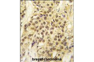 Formalin-fixed and paraffin-embedded human breast carcinoma tissue reacted with HMOF/MYST1 antibody , which was peroxidase-conjugated to the secondary antibody, followed by DAB staining. (MYST1 Antikörper  (C-Term))