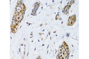 Immunohistochemistry of paraffin-embedded Human breast cancer using CIRBP Polyclonal Antibody at dilution of 1:100 (40x lens). (CIRBP Antikörper)
