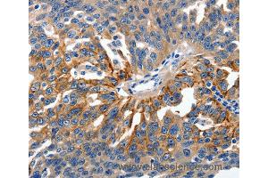 Immunohistochemistry of Human ovarian cancer using CLDN1 Polyclonal Antibody at dilution of 1:150 (Claudin 1 Antikörper)