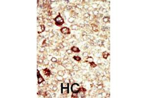 Formalin-fixed and paraffin-embedded human hepatocellular carcinoma tissue reacted with FGFR4 polyclonal antibody  , which was peroxidase-conjugated to the secondary antibody, followed by AEC staining. (FGFR4 Antikörper  (N-Term))