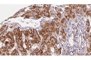 ABIN6279060 at 1/100 staining Human liver cancer tissue by IHC-P. (ACVR2B Antikörper  (Internal Region))