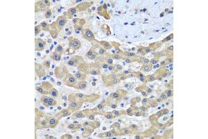 Immunohistochemistry of paraffin-embedded human liver cancer using GFM1 antibody. (GFM1 Antikörper  (AA 482-751))